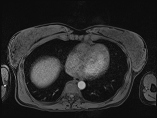 Closed loop small bowel obstruction in pregnancy (MRI) (Radiopaedia 87637-104031 Axial T1 fat sat 7).jpg