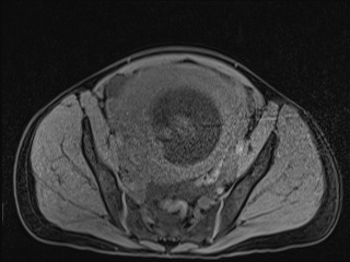 Closed loop small bowel obstruction in pregnancy (MRI) (Radiopaedia 87637-104031 F 47).jpg
