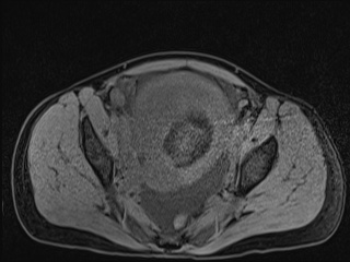 Closed loop small bowel obstruction in pregnancy (MRI) (Radiopaedia 87637-104031 F 52).jpg