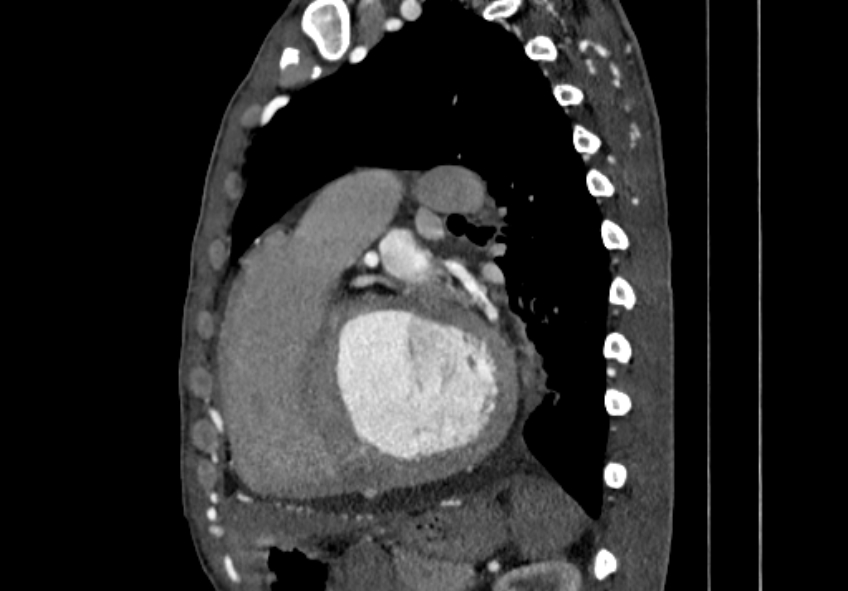 Coarctation of aorta with aortic valve stenosis (Radiopaedia 70463-80574 B 108).jpg