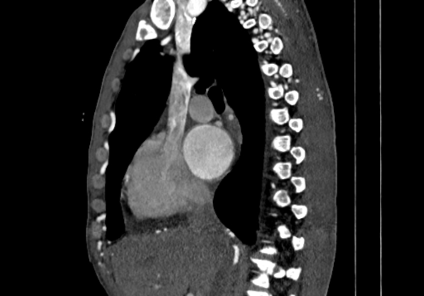 Coarctation of aorta with aortic valve stenosis (Radiopaedia 70463-80574 B 22).jpg
