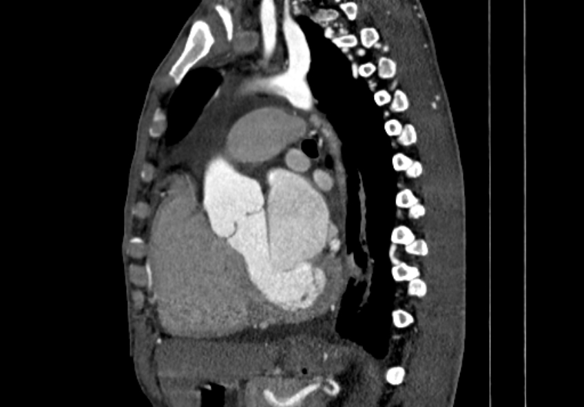 Coarctation of aorta with aortic valve stenosis (Radiopaedia 70463-80574 B 86).jpg