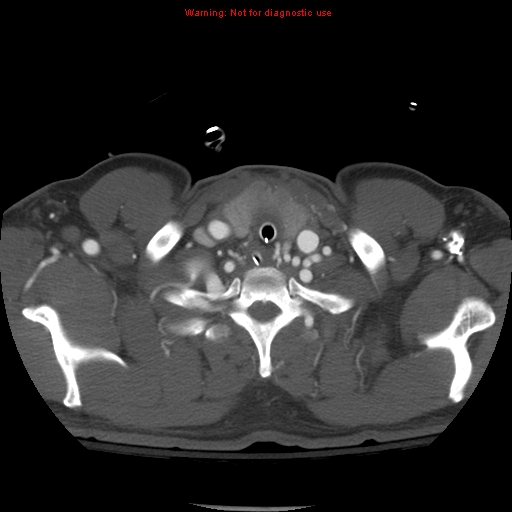 File:Coarctation of the aorta (Radiopaedia 8681-9490 B 8).jpg