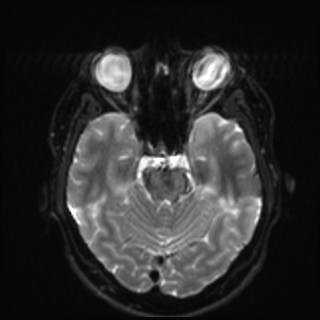 Cochlear incomplete partition type III associated with hypothalamic hamartoma (Radiopaedia 88756-105498 Axial DWI 14).jpg