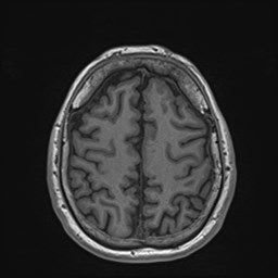 Cochlear incomplete partition type III associated with hypothalamic hamartoma (Radiopaedia 88756-105498 Axial T1 150).jpg