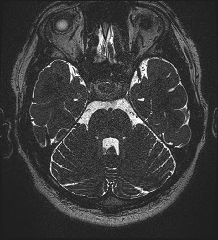 Cochlear incomplete partition type III associated with hypothalamic hamartoma (Radiopaedia 88756-105498 Axial T2 108).jpg