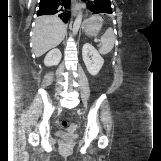 Collection due to leak after sleeve gastrectomy (Radiopaedia 55504-61972 B 32).jpg