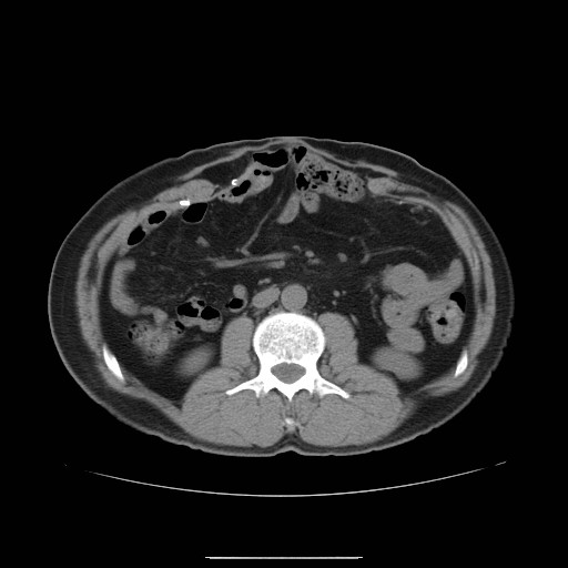 File:Colocutaneous fistula in Crohn's disease (Radiopaedia 29586-30093 Axial non-contrast 3).jpg