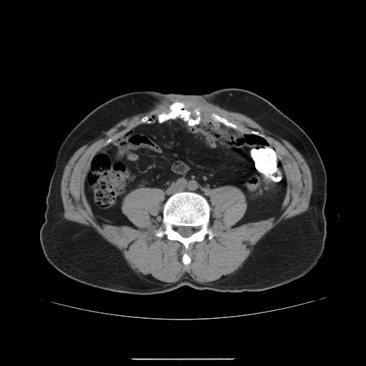 File:Colocutaneous fistula in Crohn's disease (Radiopaedia 29586-30093 D 14).jpg