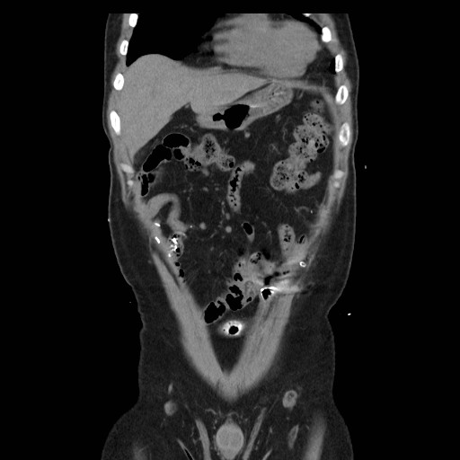 File:Colocutaneous fistula in Crohn's disease (Radiopaedia 29586-30093 E 2).jpg