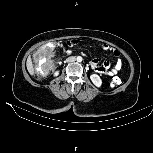 Colon adenocarcinoma (Radiopaedia 91240-108842 A 44).jpg