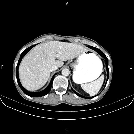 Colon adenocarcinoma - hepatic flexure (Radiopaedia 85635-101395 A 18).jpg