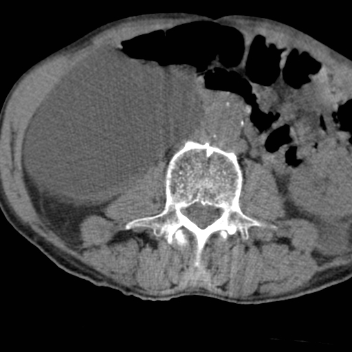 File:Colon cancer with calcified liver metastasis (Radiopaedia 74423-85309 Axial non-contrast 51).jpg