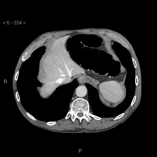 Colonic cancer (ultrasound and TC imaging) (Radiopaedia 50346-55713 B 334).jpg