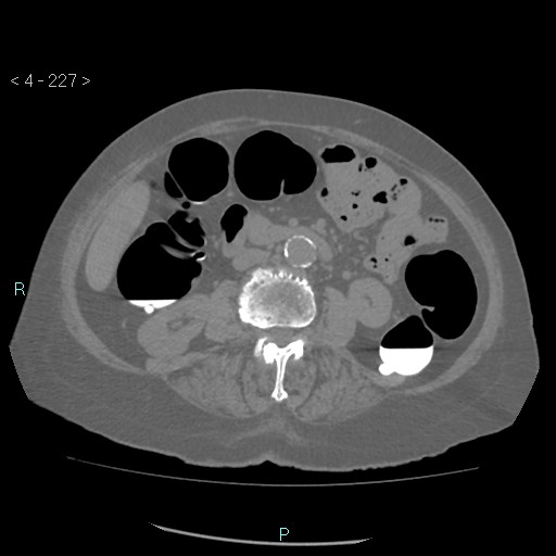 File:Colonic lipomas (Radiopaedia 49137-54244 Axial bone window 101).jpg