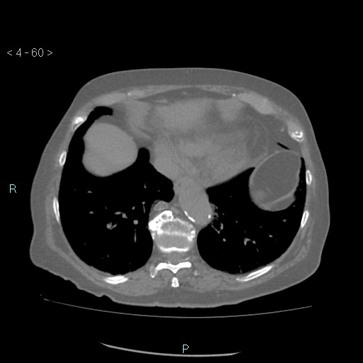 Colonic lipomas (Radiopaedia 49137-54244 Axial bone window 28).jpg