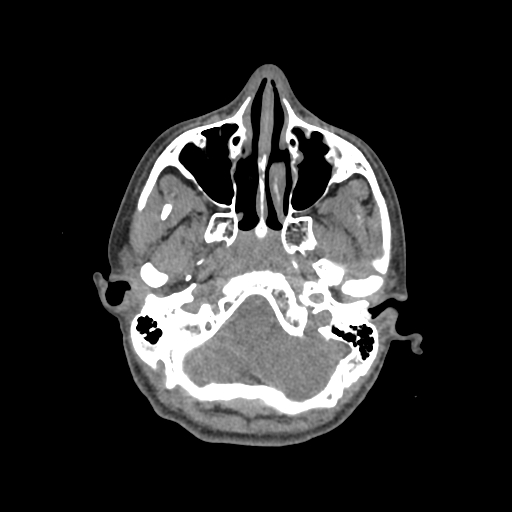 Nasal pyogenic granuloma (lobular capillary hemangioma) (Radiopaedia 85536-101244 Axial non-contrast 63).jpg