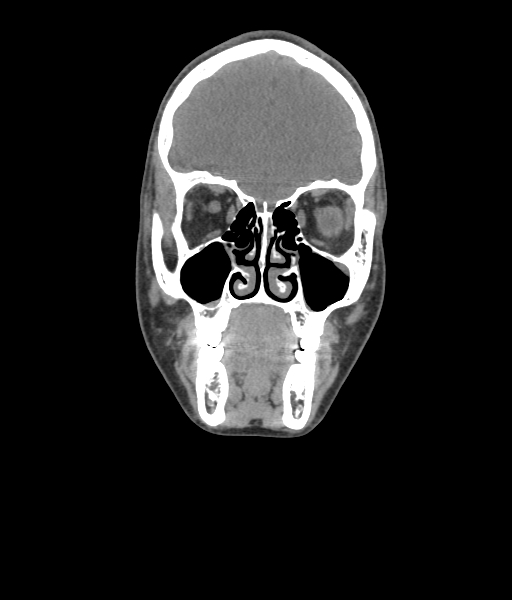 Nasal pyogenic granuloma (lobular capillary hemangioma) (Radiopaedia 85536-101244 Coronal non-contrast 78).jpg