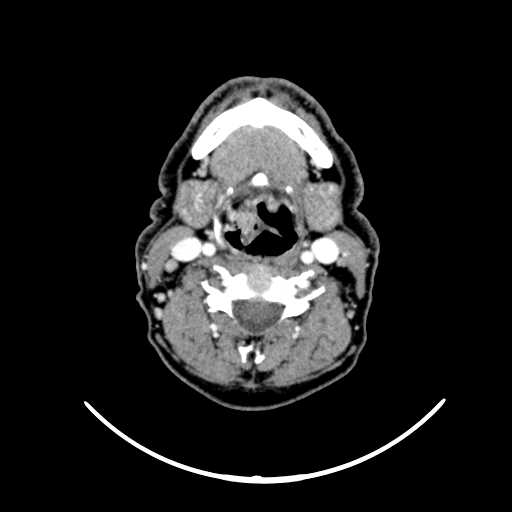 File:Nasopharyngeal carcinoma - infiltrating the clivus (Radiopaedia 62583-70875 Axial Post contrast 43).jpg