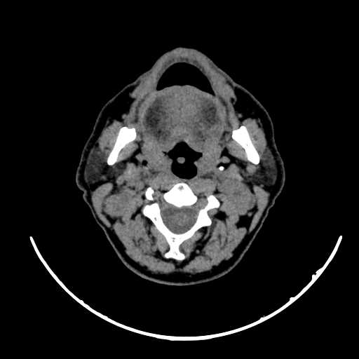 Nasopharyngeal carcinoma - infiltrating the clivus (Radiopaedia 62583-70875 Axial non-contrast 29).jpg