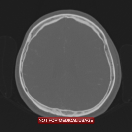 File:Nasopharyngeal carcinoma recurrence - skull base destruction (Radiopaedia 29107-29490 Axial bone window 36).jpg