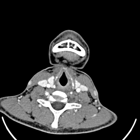 Nasopharyngeal carcinoma with skull base invasion (Radiopaedia 53415-59705 A 155).jpg