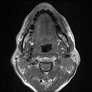 Nasopharyngeal carcinoma with skull base invasion (Radiopaedia 59258-66600 B 34).jpg