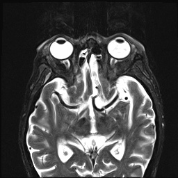 File:Nasopharyngeal carcinoma with skull base invasion (Radiopaedia 59258-66600 D 4).jpg