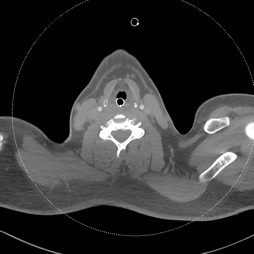File:Neck CT angiogram (intraosseous vascular access) (Radiopaedia 55481-61945 B 165).jpg