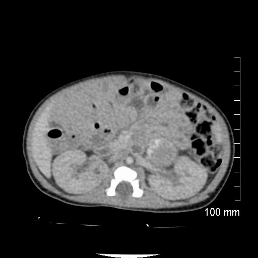 File:Neonatal neuroblastoma (Radiopaedia 56651-63438 Axial non-contrast 39).jpg