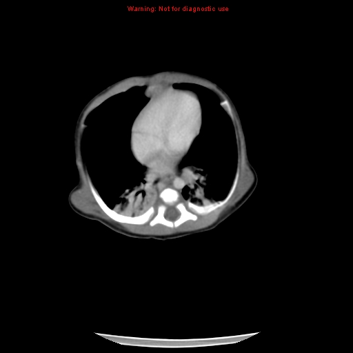 File:Neonatal neuroblastoma (Radiopaedia 9564-10223 A 11).jpg