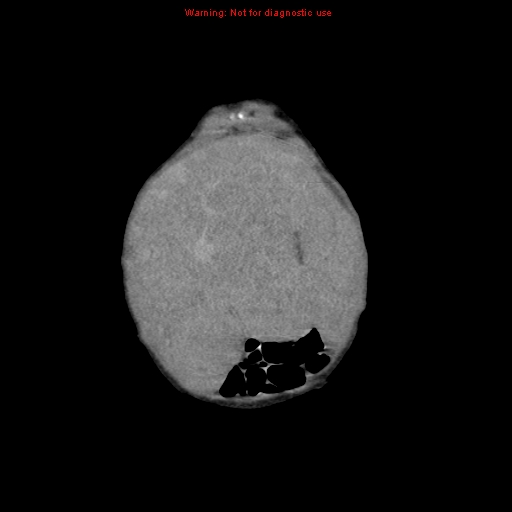 File:Neonatal neuroblastoma (Radiopaedia 9564-10223 B 22).jpg