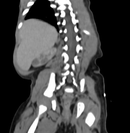Nephroblastomatosis (Radiopaedia 71294-81607 B 271).jpg