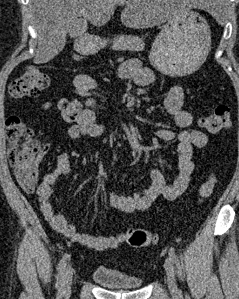 File:Nephrostomy for urosepsis (Radiopaedia 26180-26330 non-contrast 35).jpg