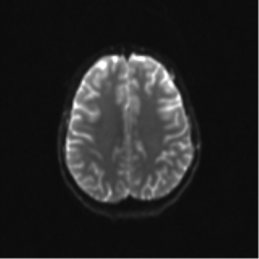 Neurenteric cyst (Radiopaedia 58641-65837 Axial DWI 26).png