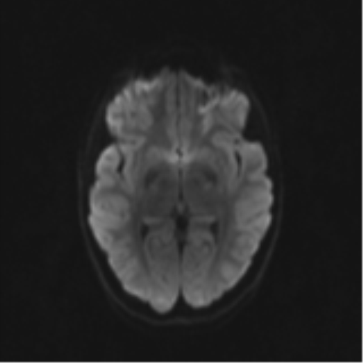 Neurenteric cyst (Radiopaedia 58641-65837 Axial DWI 52).png
