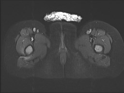 File:Neuroblastoma with bone metastases (Radiopaedia 67080-76414 Axial STIR 39).jpg