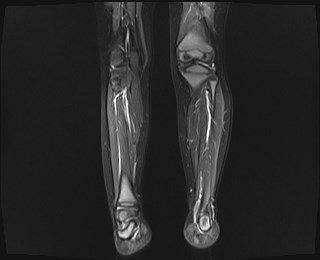 File:Neuroblastoma with bone metastases (Radiopaedia 67080-76414 B 10).jpg