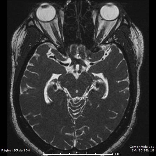 Neurocysticercosis (Radiopaedia 58636-65832 I 95).jpg