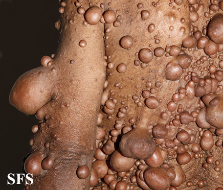 File:Neurofibromatosis (Dermatology Atlas 35).jpg
