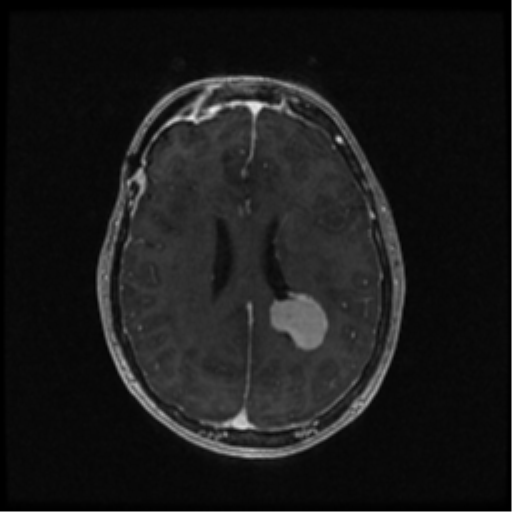 Neurofibromatosis type 2 (Radiopaedia 45229-49244 Axial T1 C+ 77).png