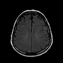 File:Neurofibromatosis type 2 (Radiopaedia 8713-9518 Axial FLAIR 8).jpg