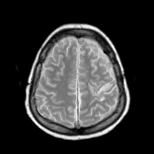 File:Neurofibromatosis type 2 (Radiopaedia 8713-9518 Axial Gradient Echo 6).jpg