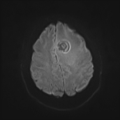 File:Neurotoxoplasmosis - concentric target sign (Radiopaedia 70644-80784 Axial DWI 17).jpg