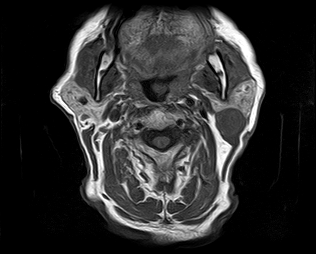 File:Non-Hodgkin lymphoma - parotid gland (Radiopaedia 71531-81890 Axial T1 11).jpg