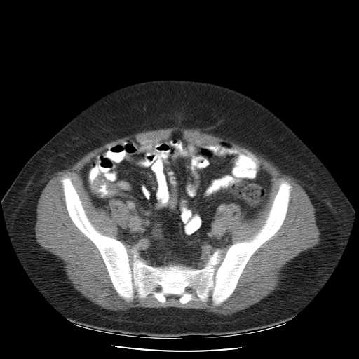 File:Non-Hodgkin lymphoma involving pelvis (Radiopaedia 21281-21197 A 49).jpg