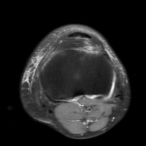 File:Non-displaced patella fracture (Radiopaedia 15932-15582 Axial PD fat sat 18).jpg