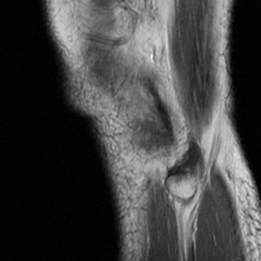 File:Non-displaced patella fracture (Radiopaedia 15932-15582 Sagittal T1 19).jpg
