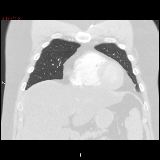 File:Non-specific interstitial pneumonitis (Radiopaedia 27044-27222 Coronal lung window 11).jpg