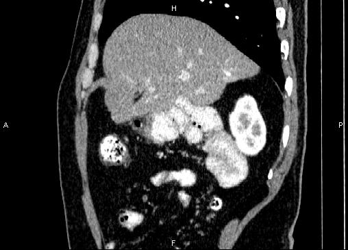 Non-syndromic pancreatic endocrine tumor (Radiopaedia 86958-103178 E 27).jpg